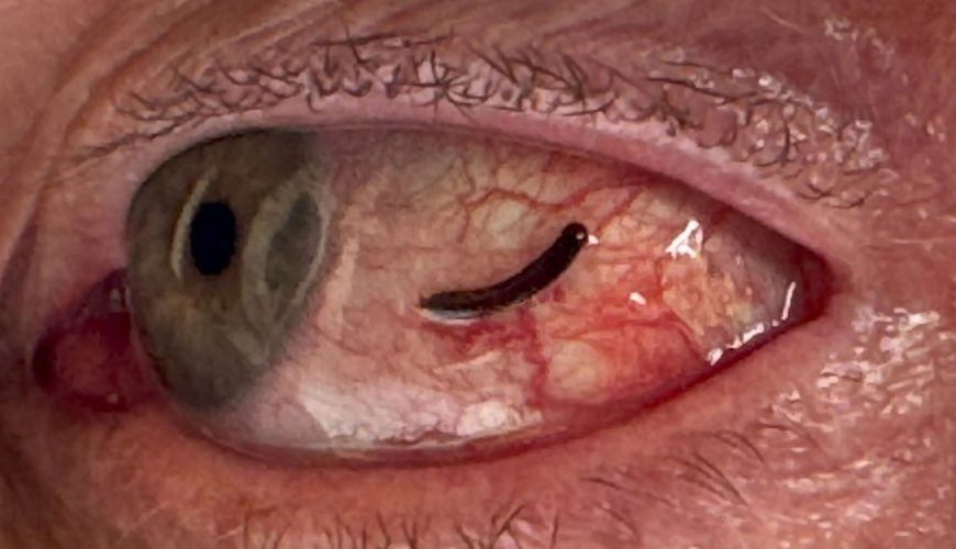 Horrifying photos show the true cause of man’s itchy eye – after he found a LEECH feasting on his eyeball