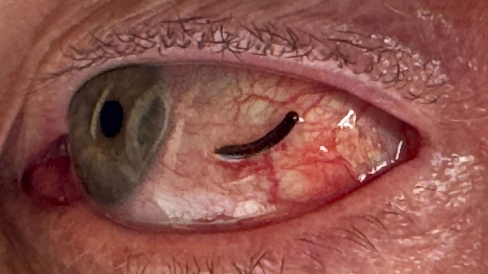 Horrifying photos show the true cause of man’s itchy eye – after he found a LEECH feasting on his eyeball